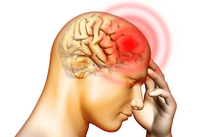 Accidente cerebrovascular