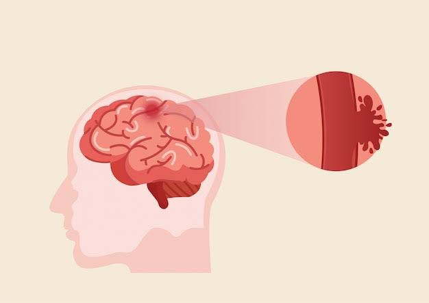 Accidente cerebrovascular