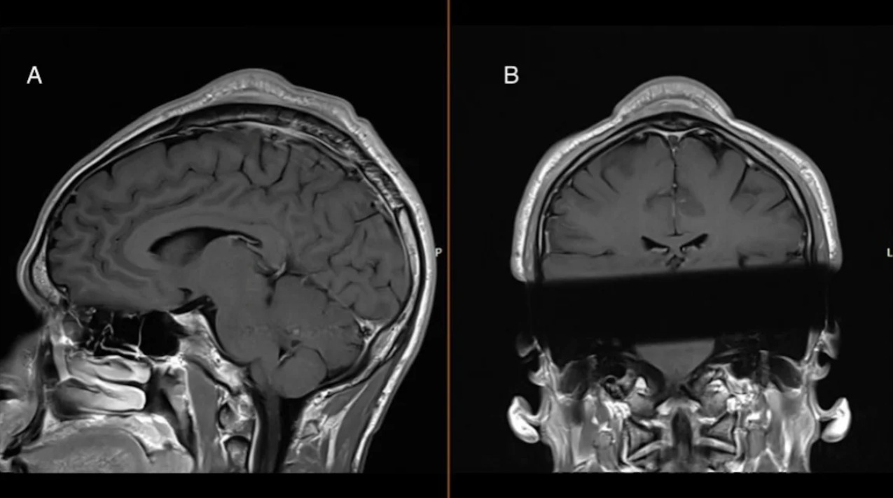 Tumor por headspin. (BMJ)