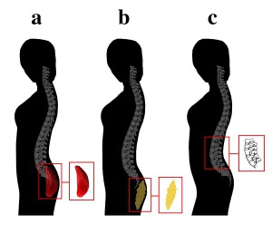 Protrusión de los glúteos asociada con (a) el desarrollo de los glúteos, lo que indica aptitud física, (b) la deposición de tejido adiposo y (c) el acuñamiento vertebral.